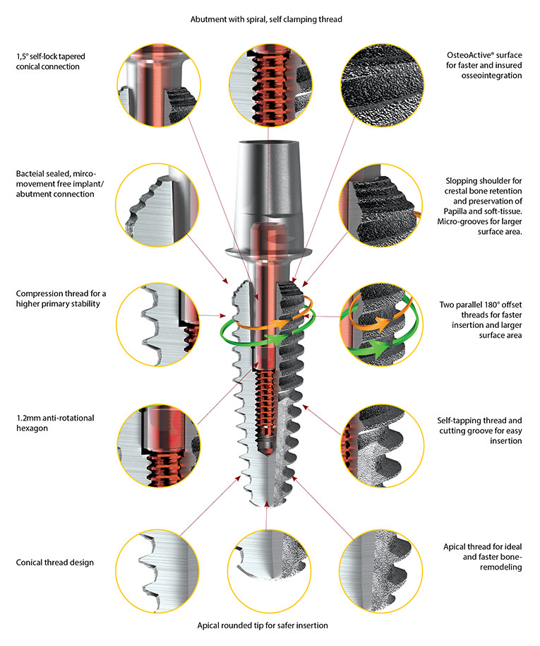 Rapid Implants